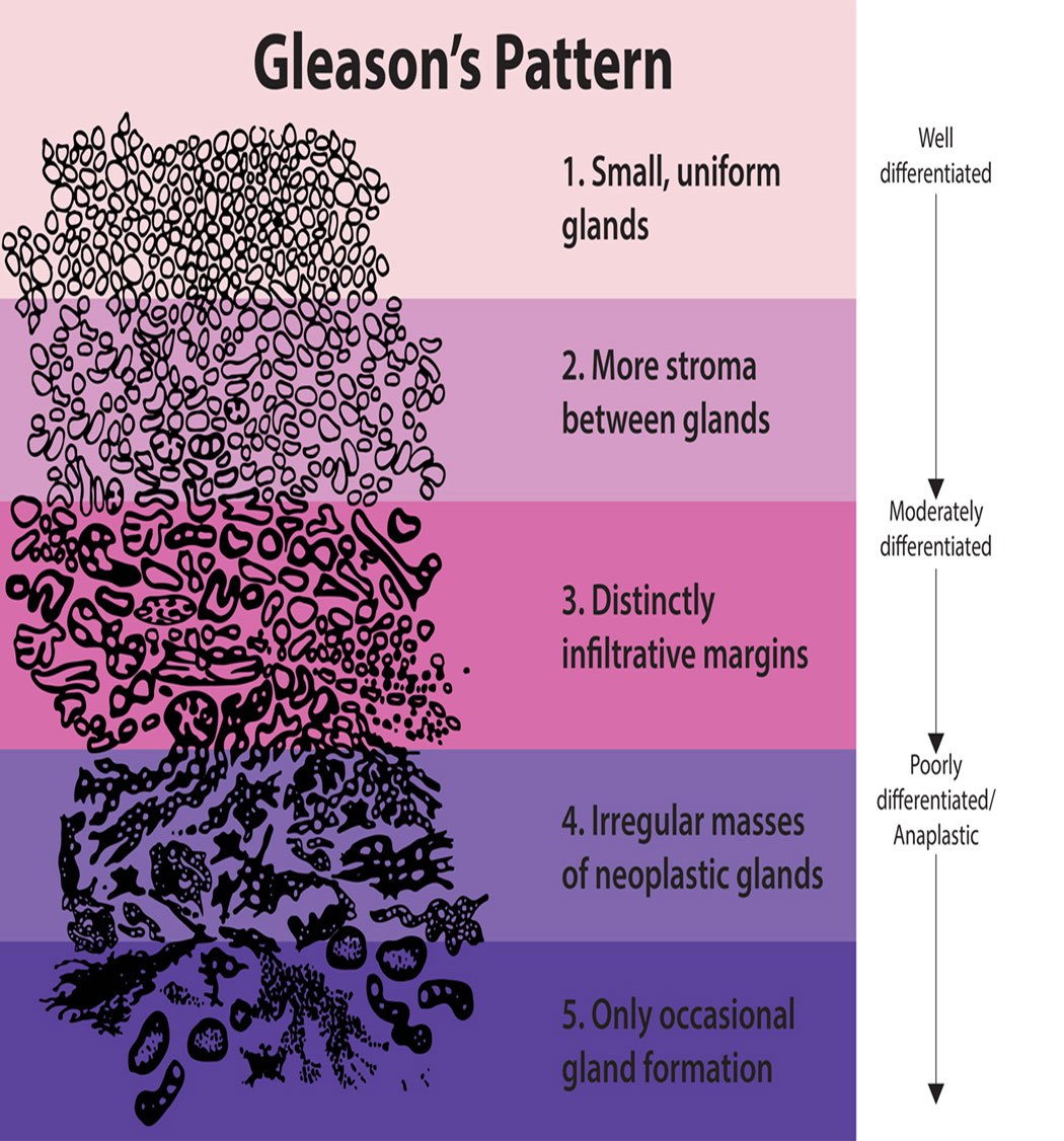 GLEASON CHART