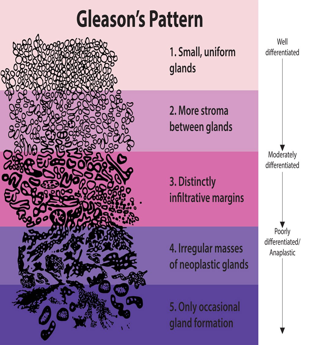 What Is The Lowest Gleason Score For Prostate Cancer