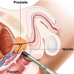 Diagram of TRUS biopsy showing needle and probe