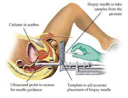 Diagram of a transperineal biopsy