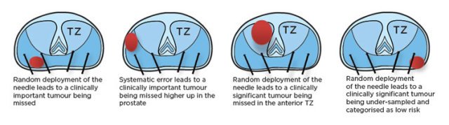 Diagram of TRUS biopsy issues