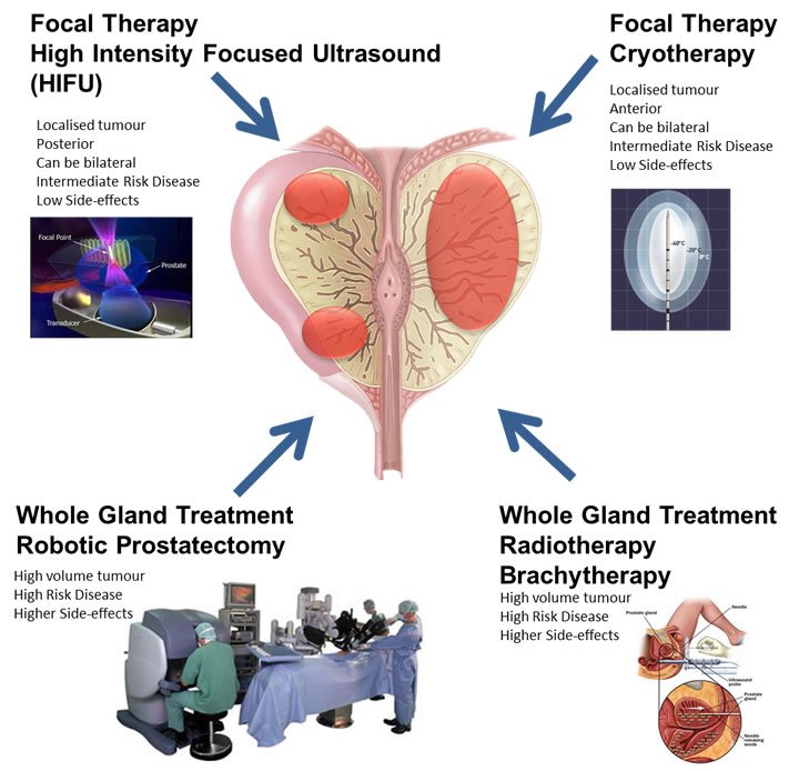 Diagram of some Prostate Cancer treatment options