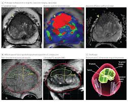 Prostate MRI images