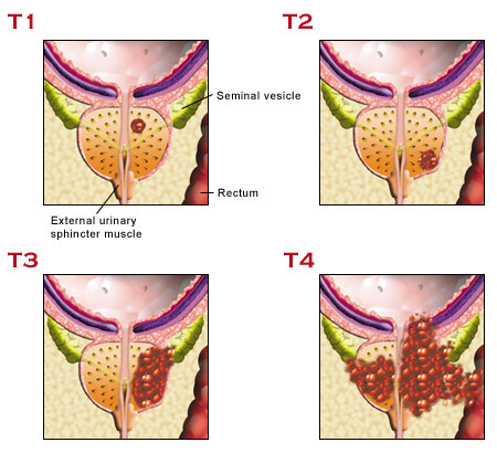 Diagram of prostate cancer stages