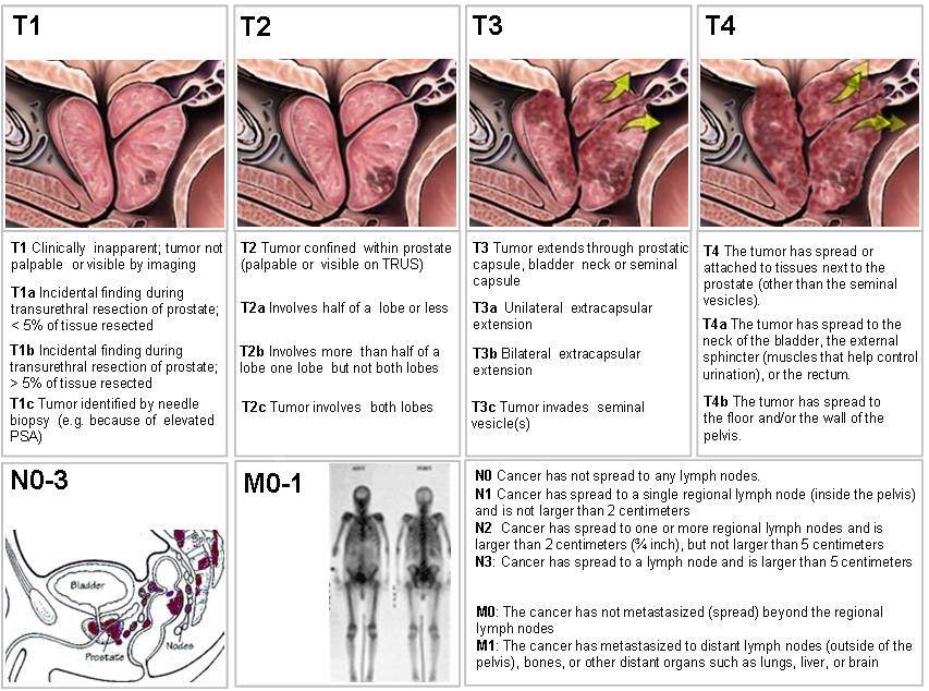 stage 3 prostate cancer treatment