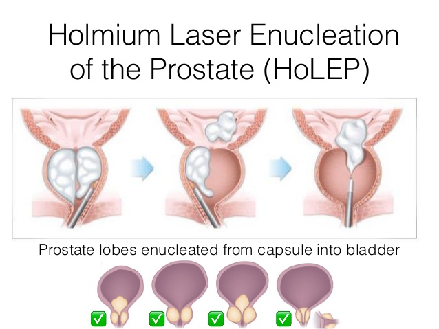 holmium laser prostate enucleation prostatita cronica la sotul meu