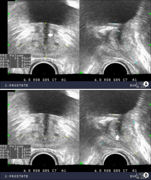 Prostate volume ultrasound images