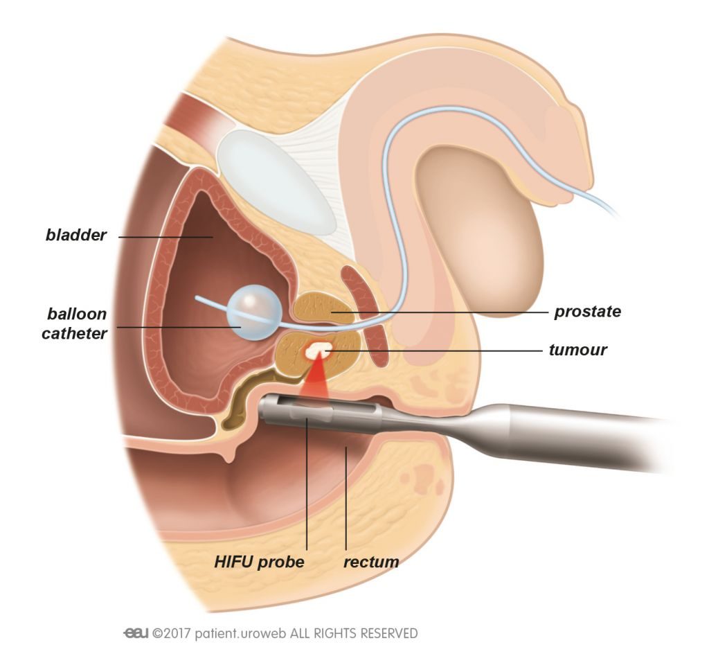 Diagram of HIFU Sonablate probe in operation