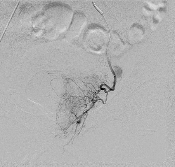 Prostatic Artery