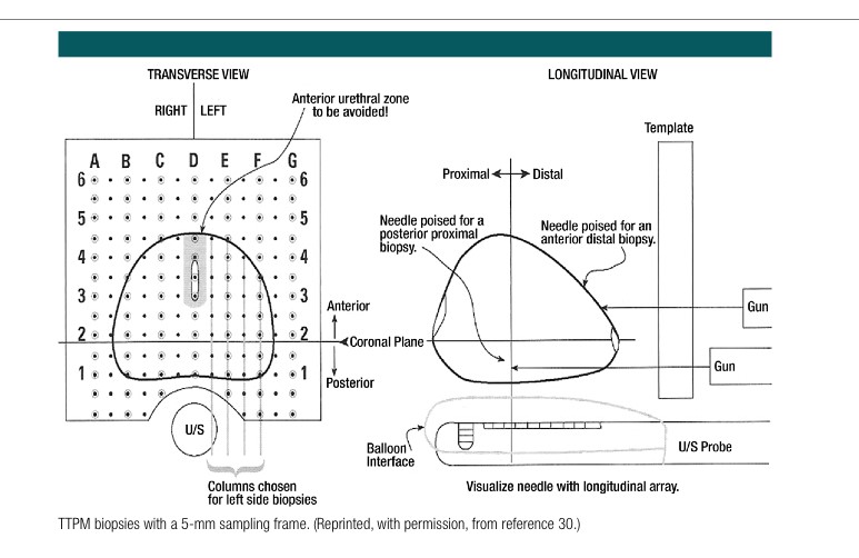 Prostate gland sampling frame