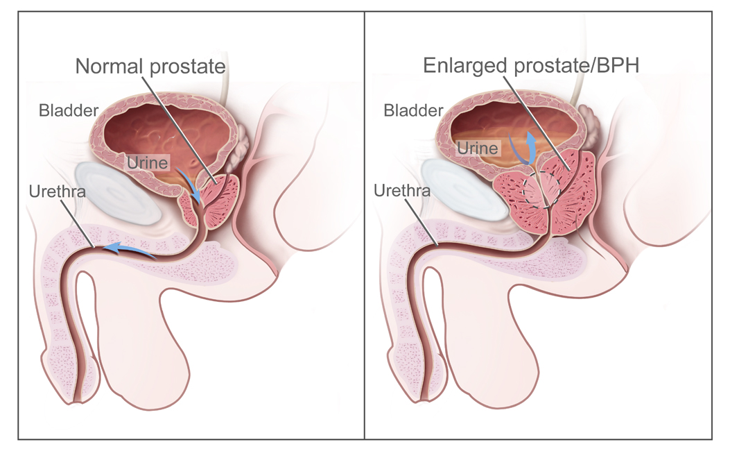 Prostatitis moderná medicína