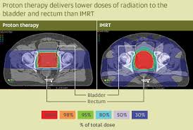 Proton beam treating prostate cancer