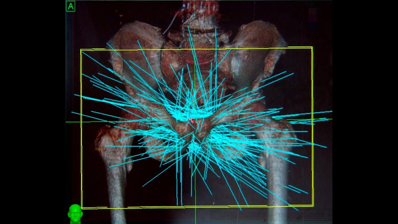 Image of Cyberknife directions of radiation beams during treatment