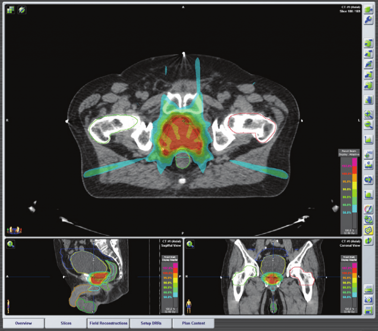 Introduction to Radiotherapy and Brachytherapy - Prostate Matters