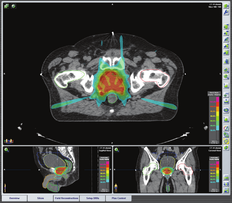 Plan-of-IMRT-Prostate-cancer-stage-cT1c-cN0-cM0-IMRT-treatment-plan-Seven-fixed