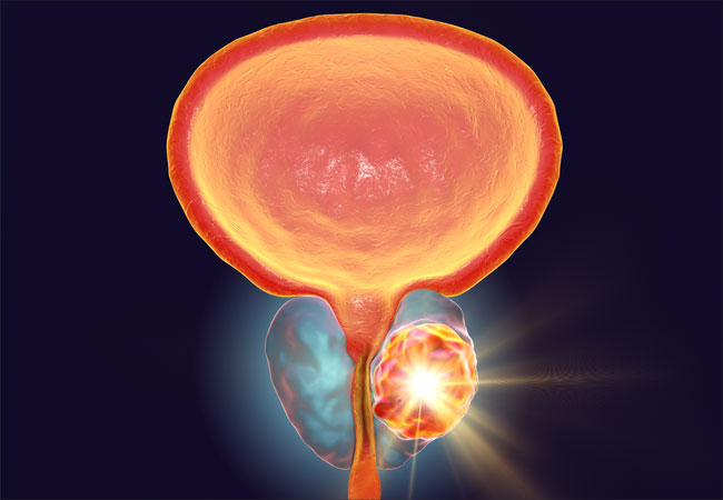 Prostate Brachytherapy treatment