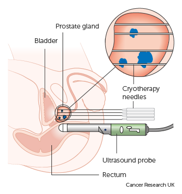 Prostate Cancer Treatment Cryotheraphy Prostate Matters