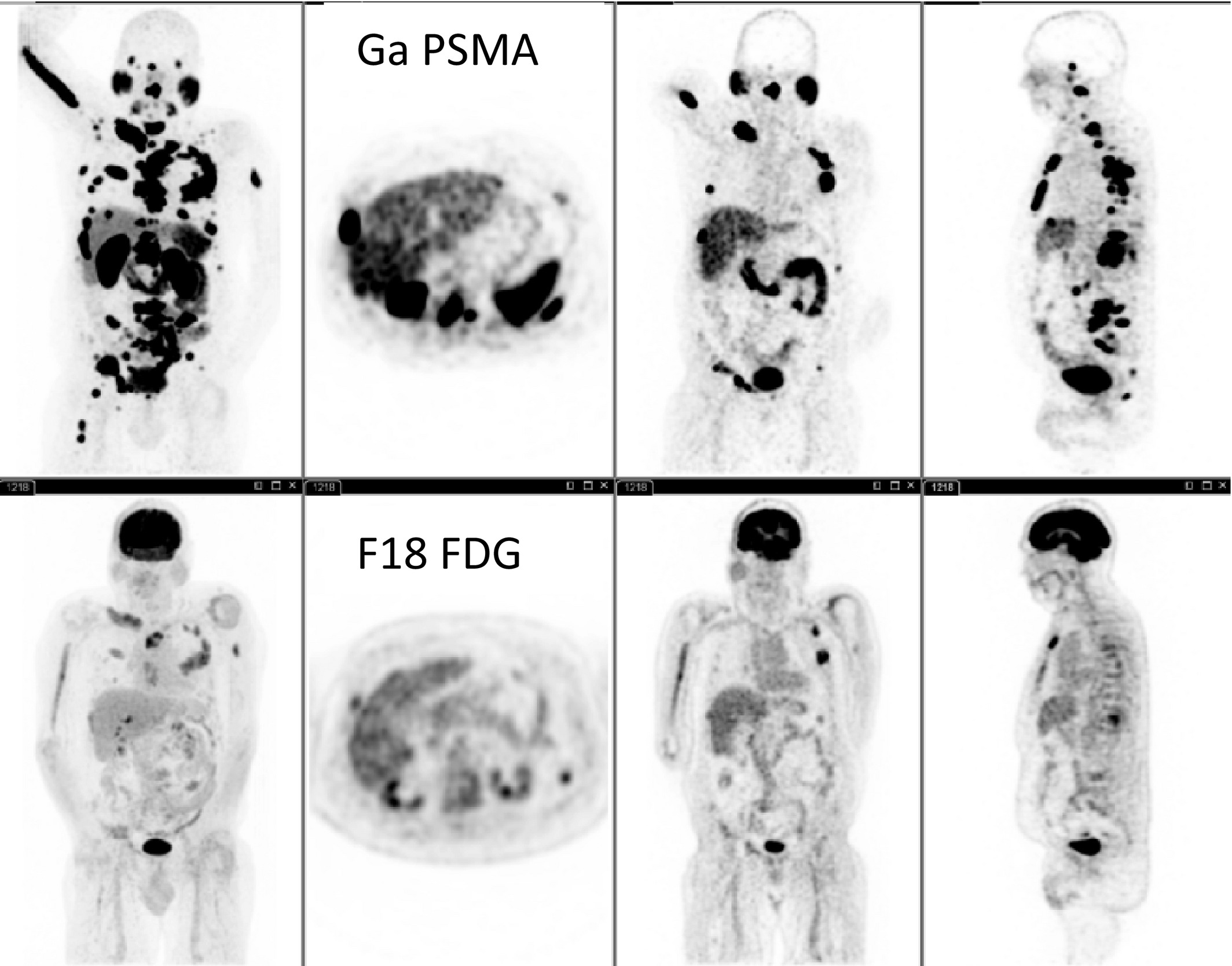 PET CT scan image showing location of prostate cancer