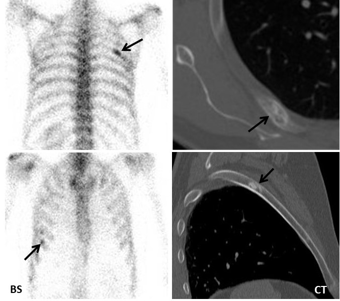 Bone and CT scans showing the location of prostate cancer