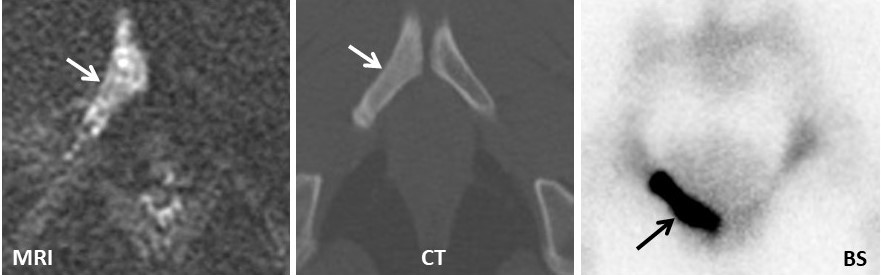 MRI CT and bone scans showing the location of prostate cancer prostate cancer