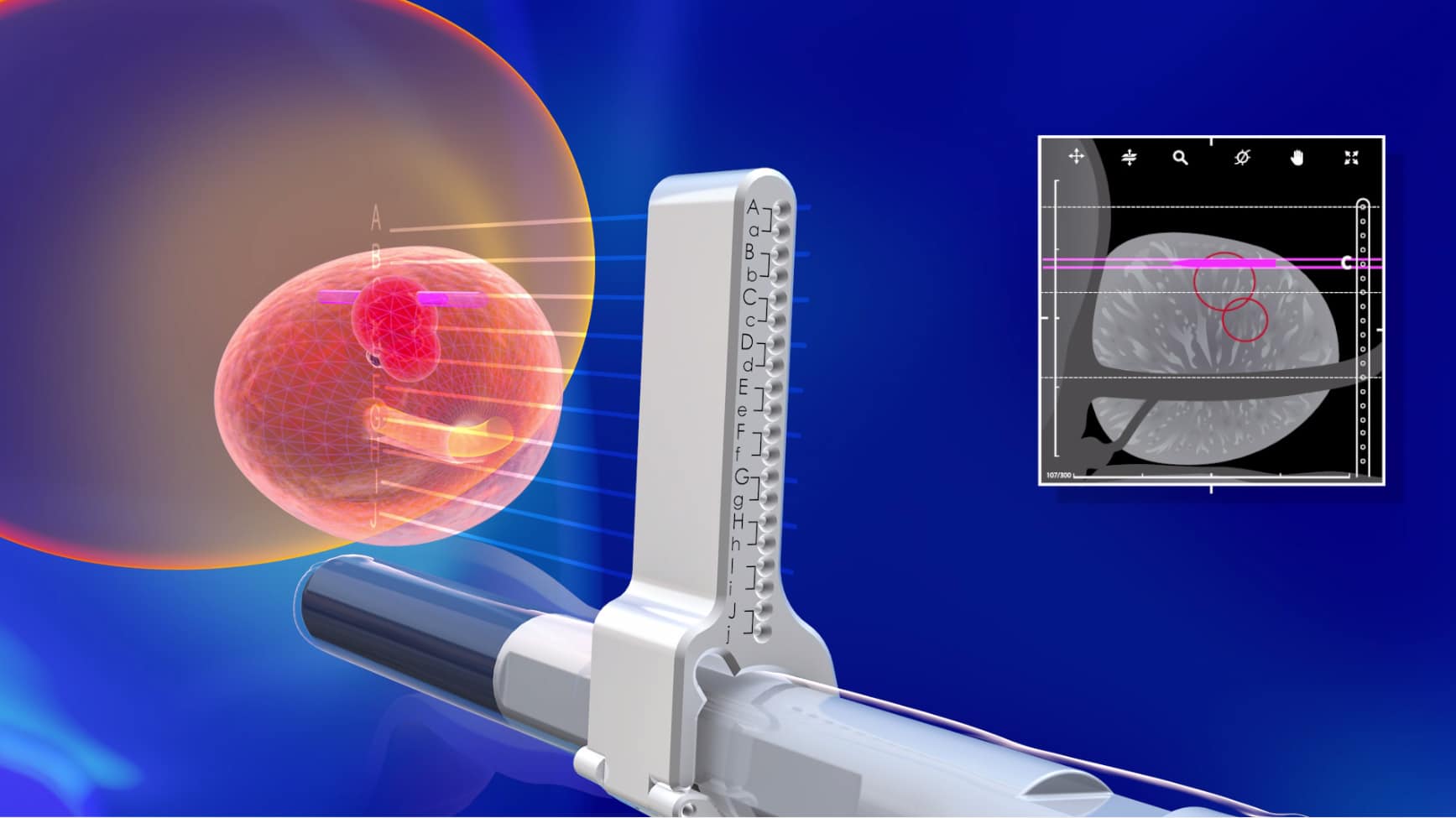 TRANSPERINEAL_VIRTUAL_BIOPSY_TRINITY