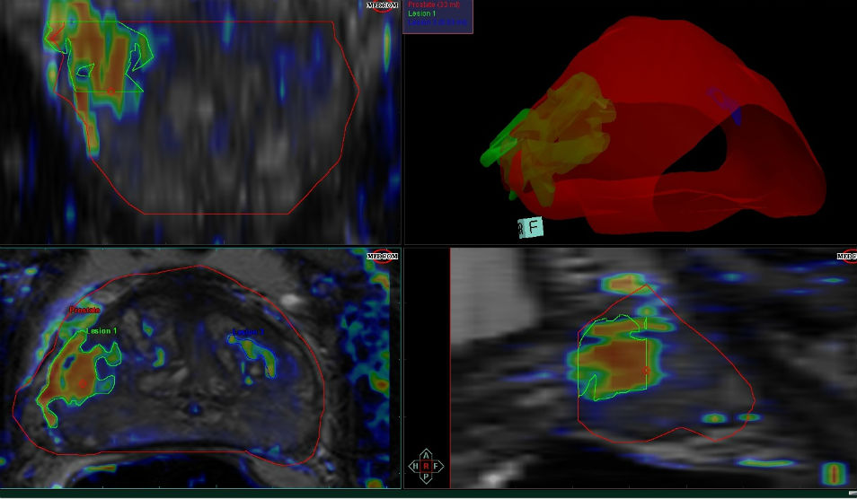 mpMR scan images showing prostate cancer lesions