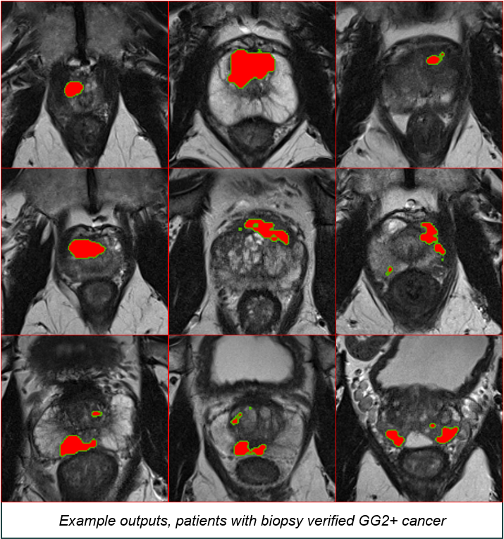 Scans showing cancer