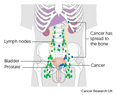 Figure1 Metastatic prostate cancer diagram